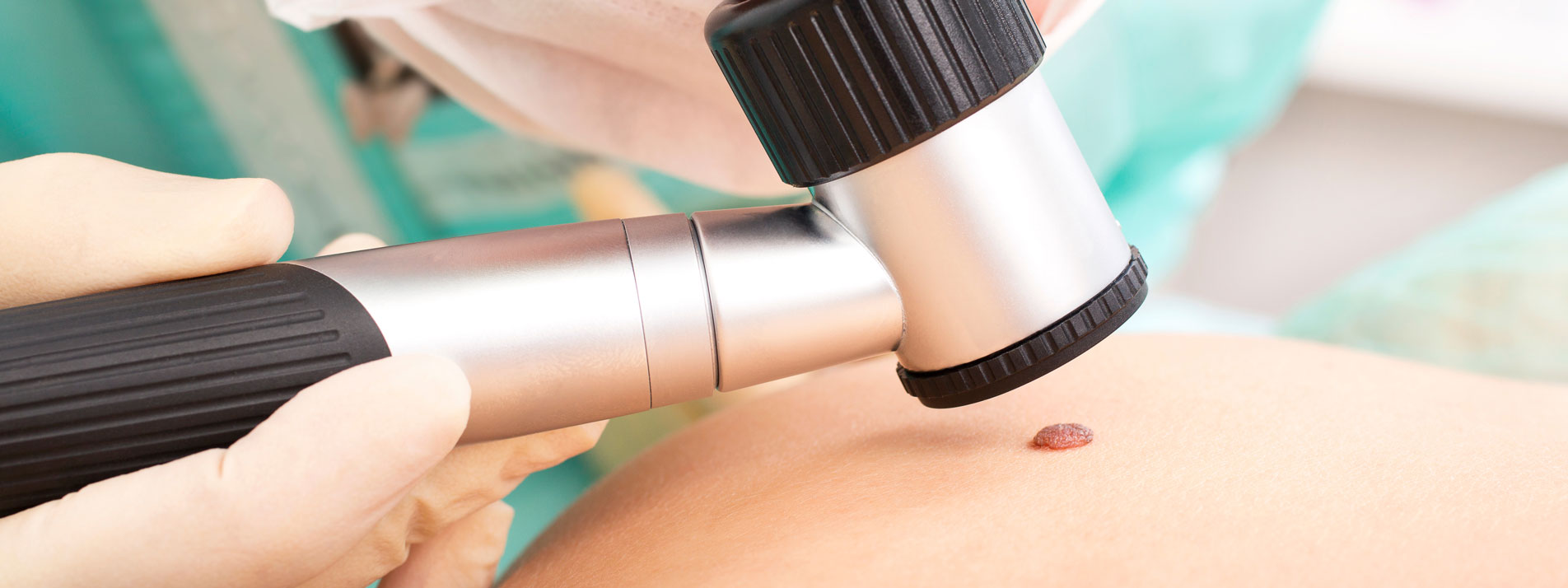 Dermatoskopie in der Dermatologie Praxis Hautarzt Dr. Mader & Kollegen in Duisburg-Homberg