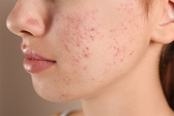 Akne · MVZ MADERMA GmbH Dr. Mader & Kollegen · Hautarzt Praxis Duisburg-Homberg ·