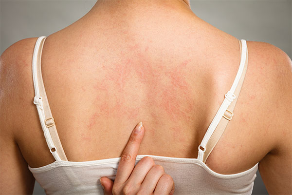 Hautausschläge / Ekzeme · MVZ MADERMA GmbH Dr. Mader & Kollegen · Hautarzt Praxis Duisburg-Homberg ·