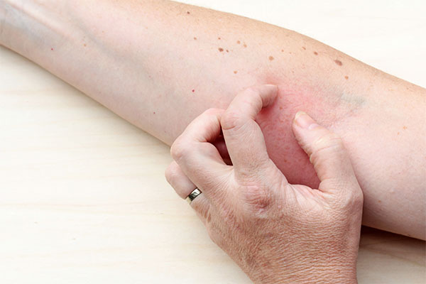 Neurodermitis (atopisches Ekzem) · MVZ MADERMA GmbH Dr. Mader & Kollegen · Hautarzt Praxis Duisburg-Homberg ·
