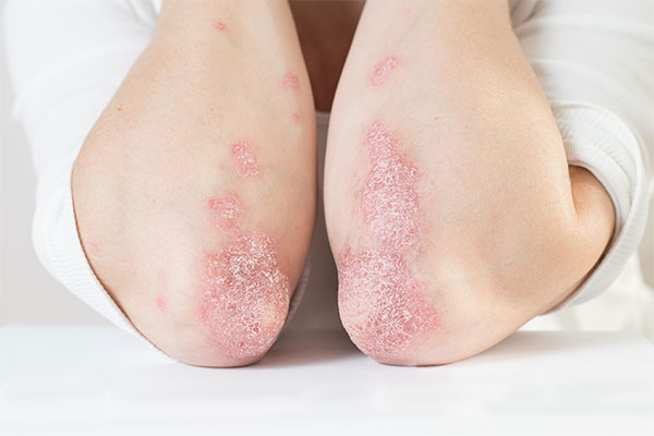 Schuppenflechte (Psoriasis) · MVZ MADERMA GmbH Dr. Mader & Kollegen · Hautarzt Praxis Duisburg-Homberg ·